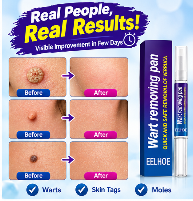 Wart Remover Gel Pen (Imported )